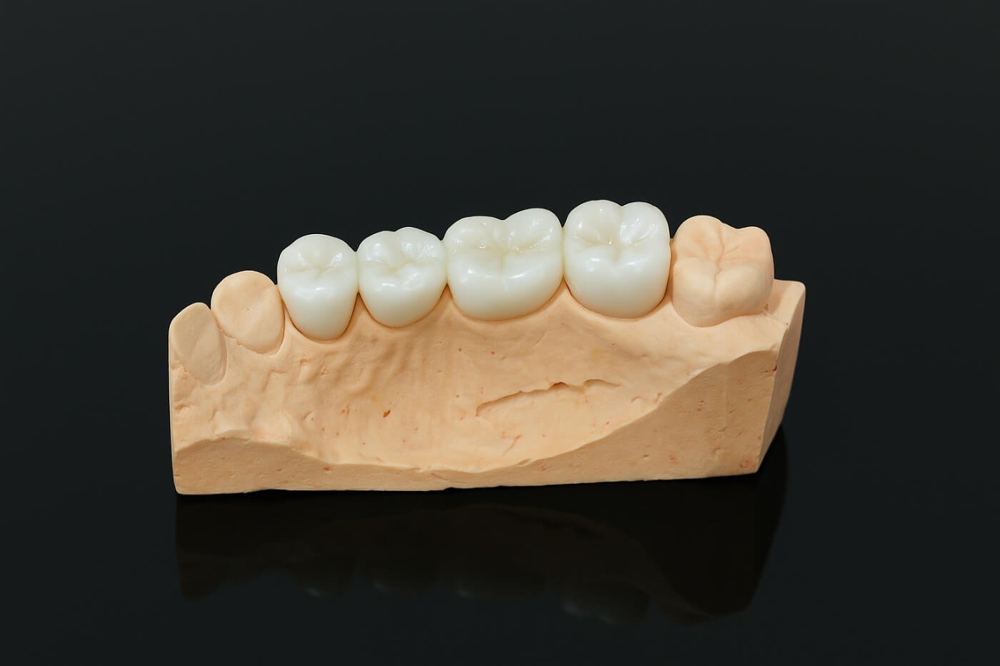 Γέφυρες ζιρκονίου