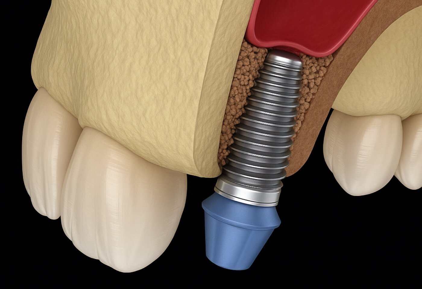 Ανύψωση ιγμορείου