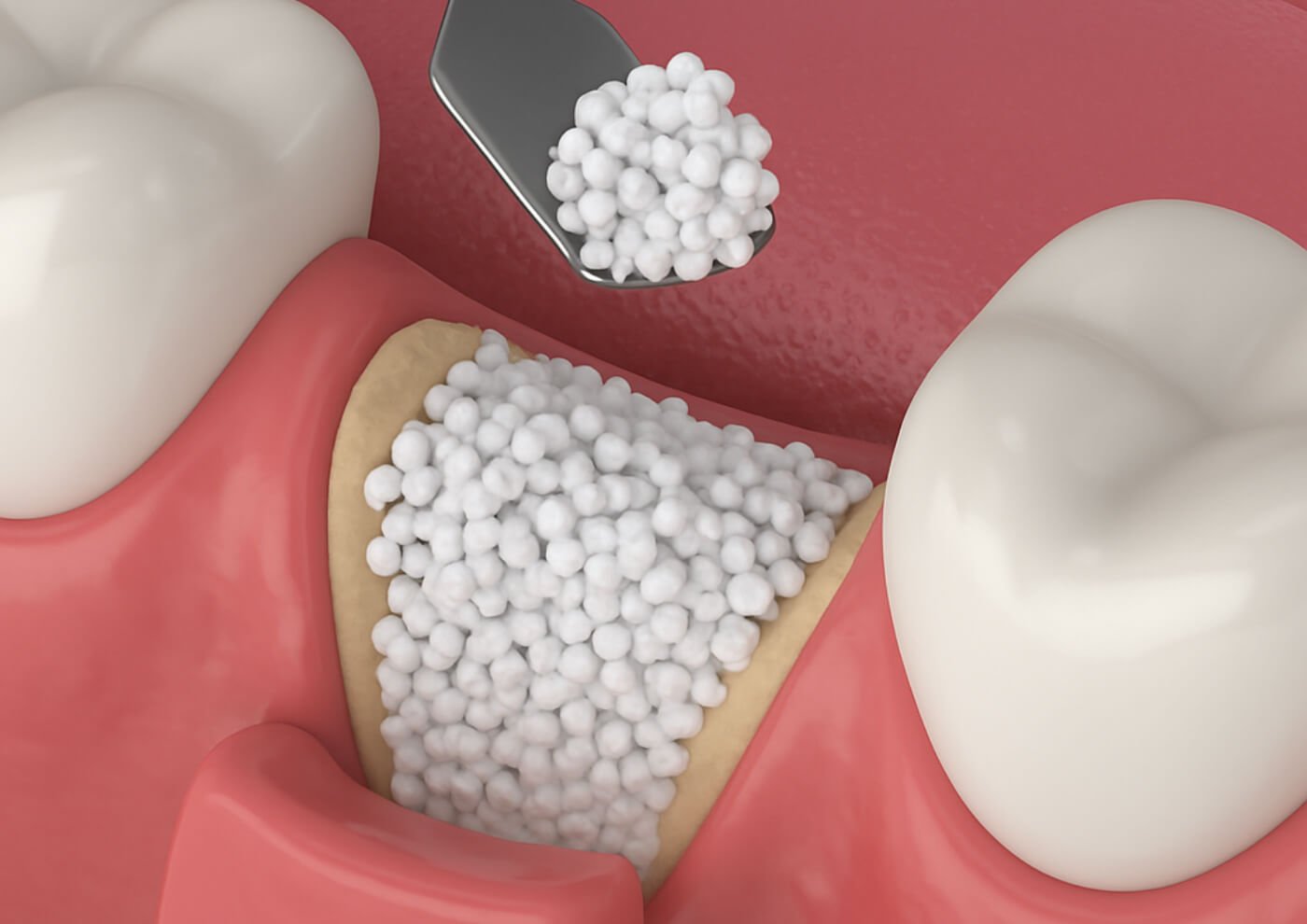 Οστικά μοσχεύματα