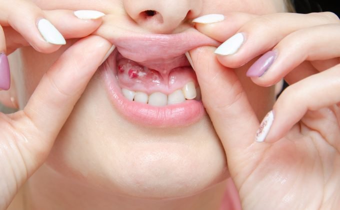 Αφαίρεση κύστεων